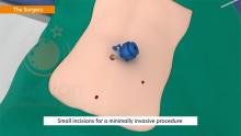 Laparoscopic Appendectomy